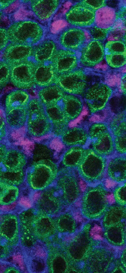  A schematic and single z-slice confocal image of the upd tumor. The tumor lacks a stem-cell niche and is composed of GSC-like (green; Vasa-positive) and CySC-like (magenta; Zfh1-positive) cells. In blue, is the cell adhesion protein armadillo (Arm) and the spectrosome (Hts), a spectrin-containing structure that appears as a dot in the cytoplasm of GSCs. The Vasa-positive, spectrosome-containing germline cells in the upd tumor display a morphology that is consistent with wild-type GSCs. Scale bar = 10 µm.