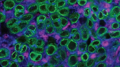  A schematic and single z-slice confocal image of the upd tumor. The tumor lacks a stem-cell niche and is composed of GSC-like (green; Vasa-positive) and CySC-like (magenta; Zfh1-positive) cells. In blue, is the cell adhesion protein armadillo (Arm) and the spectrosome (Hts), a spectrin-containing structure that appears as a dot in the cytoplasm of GSCs. The Vasa-positive, spectrosome-containing germline cells in the upd tumor display a morphology that is consistent with wild-type GSCs. Scale bar = 10 µm.