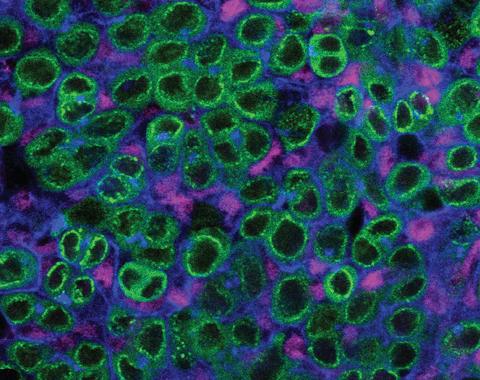  A schematic and single z-slice confocal image of the upd tumor. The tumor lacks a stem-cell niche and is composed of GSC-like (green; Vasa-positive) and CySC-like (magenta; Zfh1-positive) cells. In blue, is the cell adhesion protein armadillo (Arm) and the spectrosome (Hts), a spectrin-containing structure that appears as a dot in the cytoplasm of GSCs. The Vasa-positive, spectrosome-containing germline cells in the upd tumor display a morphology that is consistent with wild-type GSCs. Scale bar = 10 µm.