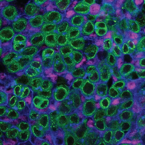  A schematic and single z-slice confocal image of the upd tumor. The tumor lacks a stem-cell niche and is composed of GSC-like (green; Vasa-positive) and CySC-like (magenta; Zfh1-positive) cells. In blue, is the cell adhesion protein armadillo (Arm) and the spectrosome (Hts), a spectrin-containing structure that appears as a dot in the cytoplasm of GSCs. The Vasa-positive, spectrosome-containing germline cells in the upd tumor display a morphology that is consistent with wild-type GSCs. Scale bar = 10 µm.